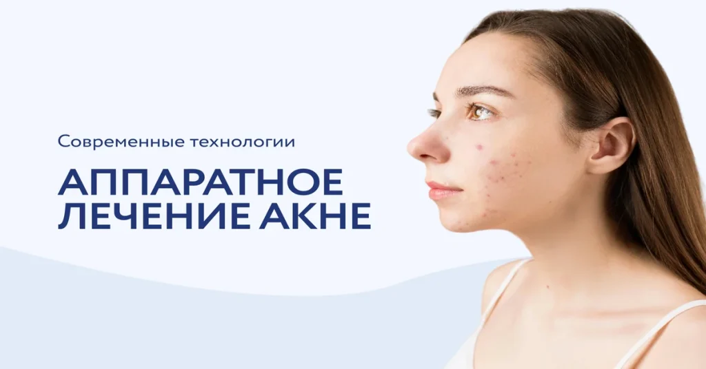 Инновационные аппараты для лечения акне: перспективы и возможности современной дерматологии